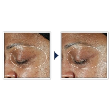 RoC Multi Correxion Anti-Aging Eye Cream for Youthful Eyes