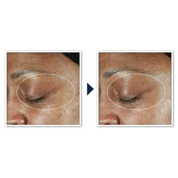 RoC Multi Correxion Anti-Aging Eye Cream for Youthful Eyes