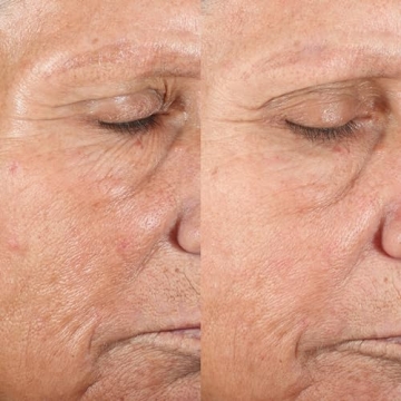 PMD Beauty Microderm Classic | Home Microdermabrasion Kit for Face | Exfoliating Crystals and Suction Help Circulation to Boost Collagen for Radiant Skin