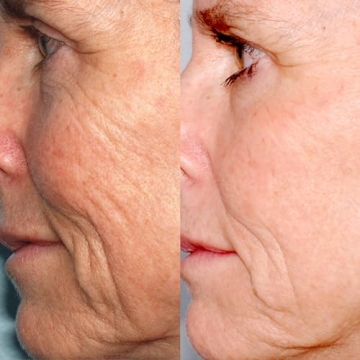 PMD Beauty Microderm Classic | Home Microdermabrasion Kit for Face | Exfoliating Crystals and Suction Help Circulation to Boost Collagen for Radiant Skin