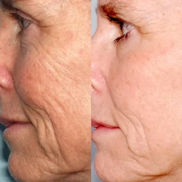 PMD Beauty Microderm Classic | Home Microdermabrasion Kit for Face | Exfoliating Crystals and Suction Help Circulation to Boost Collagen for Radiant Skin