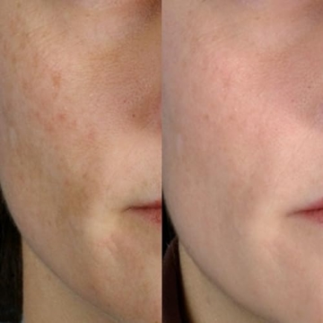 PMD Beauty Microderm Classic | Home Microdermabrasion Kit for Face | Exfoliating Crystals and Suction Help Circulation to Boost Collagen for Radiant Skin