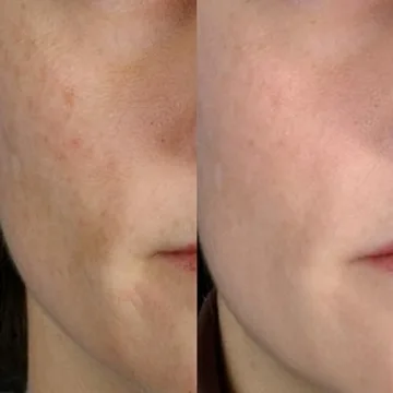 PMD Beauty Microderm Classic | Home Microdermabrasion Kit for Face | Exfoliating Crystals and Suction Help Circulation to Boost Collagen for Radiant Skin