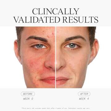 Juice Beauty Blemish Clearing Serum - Acne Treatment & Skin Clarity