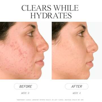 Juice Beauty Blemish Clearing Serum - Acne Treatment & Skin Clarity