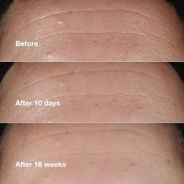 Clinique Smart Clinical Repair Wrinkle Correcting Face Serum With Hyaluronic Acid, Peptides + Advanced Retinoid Serum | Anti-Aging + Hydrating, 1 Fl Oz