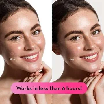 LE GUSHE Pimple Patches - Hydrocolloid Acne Treatment