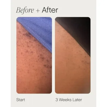 Topicals High Roller Ingrown Hair Serum for Smooth Skin