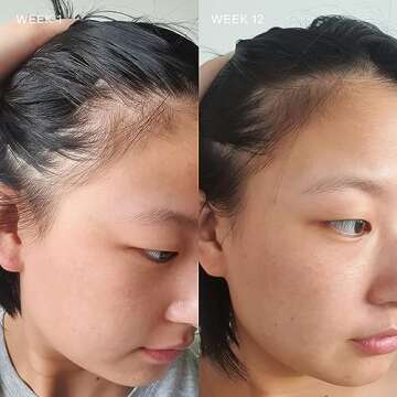 Vida Glow Hairology Hair Growth & Regrowth Capsules – Supports Thicker, Stronger Hair, Reduces Thi...