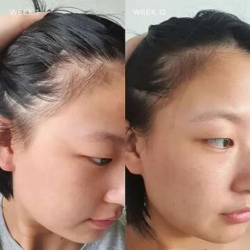 Vida Glow Hairology Hair Growth & Regrowth Capsules – Supports Thicker, Stronger Hair, Reduces Thi...