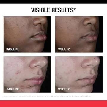 Neutrogena Retinol SA, Stubborn Marks PM Treatment, Face-Exfoliating Treatment to Help Reverse the Look of Post-Acne Marks & Uneven Skin Tone, Non-Comedogenic, PM Treatment, unscented, 1.0 Fl Oz