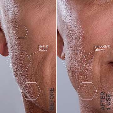 Michael Todd Beauty - Sonicsmooth - Dermaplane Razor for Women Face - SONIC Technology Dermaplaning Tool - 2 in 1 Women’s Facial Exfoliation & Peach Fuzz Hair Removal System- 8 Weeks of Safety Edges