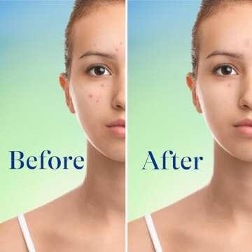 Differin Acne Face Wash 10% Benzoyl Peroxide Cleanser