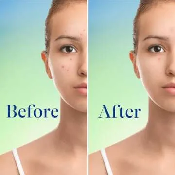 Differin Acne Face Wash 10% Benzoyl Peroxide Cleanser