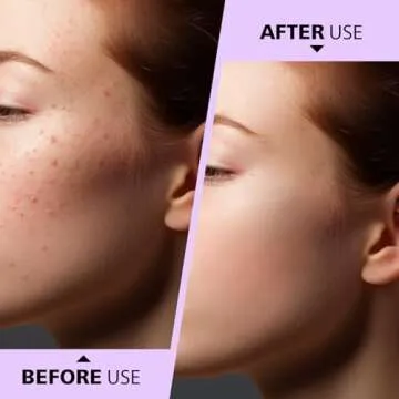 Teenitor Pimple Extractor Tool - Safe Blackhead Remover