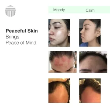 Dermazen Seborrheic Serum for All Skin Types - 4oz