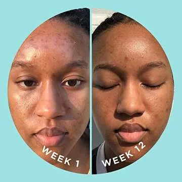 ZitSticka Vitamin Acne Supplement for Cystic Acne w/ 30 Natural Caps for Women and Men, Supplements for Hormonal Support, Skin Clarity, Dark Spots - Dermatologist Tested (Blur Potion™)