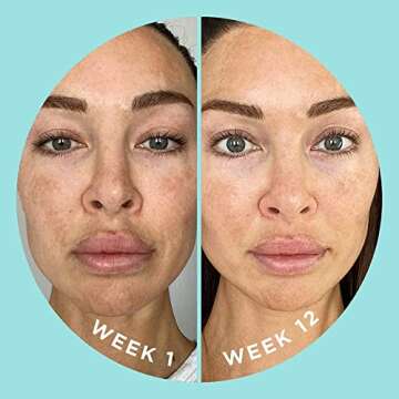 ZitSticka Vitamin Acne Supplement for Cystic Acne w/ 30 Natural Caps for Women and Men, Supplements for Hormonal Support, Skin Clarity, Dark Spots - Dermatologist Tested (Blur Potion™)