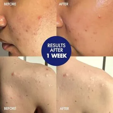 Dermisa Sulfur Bar with Aloe Vera for Oily Skin