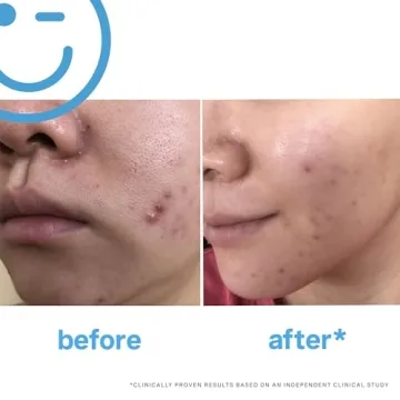 EradiKate 3% Sulfur Foaming Cleanser for Clear Skin