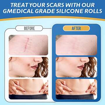 LONNIELONLI Silicone Scar Sheets for Effective Scar Healing