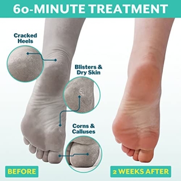 Patchology PoshPeel Pedi Cure - Ultimate Foot Peel Treatment