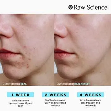 Anti Acne Supplements Cystic Acne Treatment for Teens – Hormonal Acne Pills with Acne Vitamins for Men & Women – clear skin supplement: Vitamin A, Zinc, Niacin Oily Skin & Breakout Control - 60 Caps