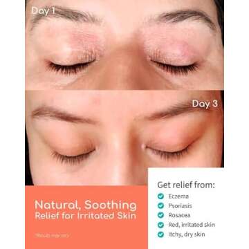 Organic Manuka Skin Soothing Cream for Eczema & Psoriasis