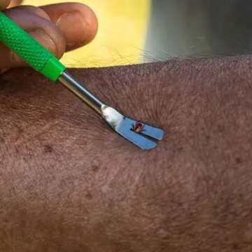 TickCheck Premium Tick Remover Kit for Safe Pet Care