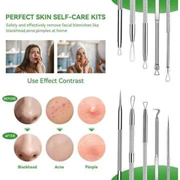5 Pcs Pimple Popper Tool Kit for Clear Skin Solutions