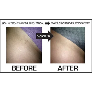 Wizker Exfoliating Brush - Ingrown Hair Prevention Tool