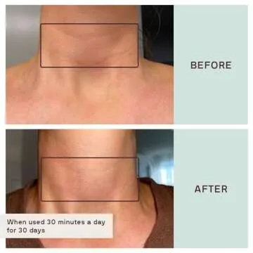 Dermaclara Neck Wrinkle Patches - Reusable Silicone Treatment