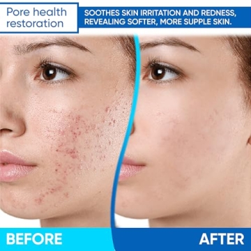 AOBBIY Azelaic Acid 12% Acne Cream for Clear Skin