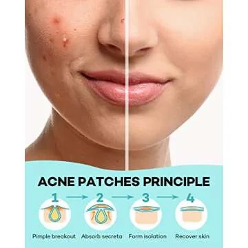 140 Acne Patches with Natural Ingredients for Clear Skin
