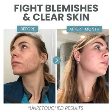 Vitamin C Serum for Face - Skin Clearing Serum with Salicylic Acid Retinol, Niacinamide and Hyaluronic Acid - Skin Brightening Acne Serum - Anti Aging Dark Spot Treatment(1 oz)