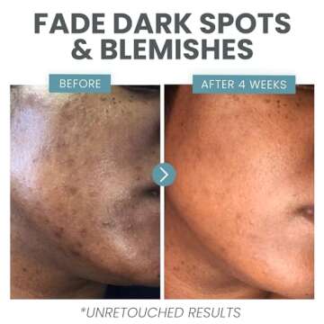 Vitamin C Serum for Face - Skin Clearing Serum with Salicylic Acid Retinol, Niacinamide and Hyaluronic Acid - Skin Brightening Acne Serum - Anti Aging Dark Spot Treatment(1 oz)