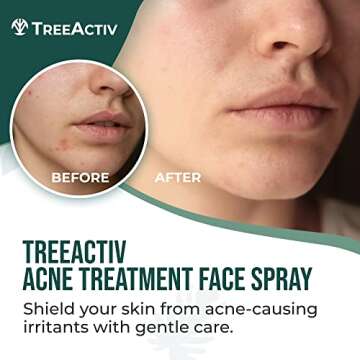 Acne Treatment Face Spray - 4 fl oz Facial Spray with Witch Hazel and Salicylic Acid