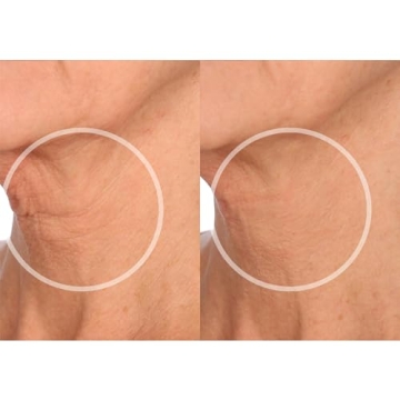 Reusable Anti-Wrinkle Patches for Neck Forehead Eye Smile
