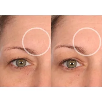 Reusable Anti-Wrinkle Patches for Neck Forehead Eye Smile