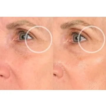 Reusable Anti-Wrinkle Patches for Neck Forehead Eye Smile