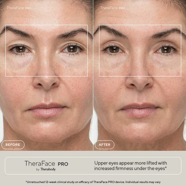 TheraFace PRO Microcurrent Facial Device for Anti-Aging