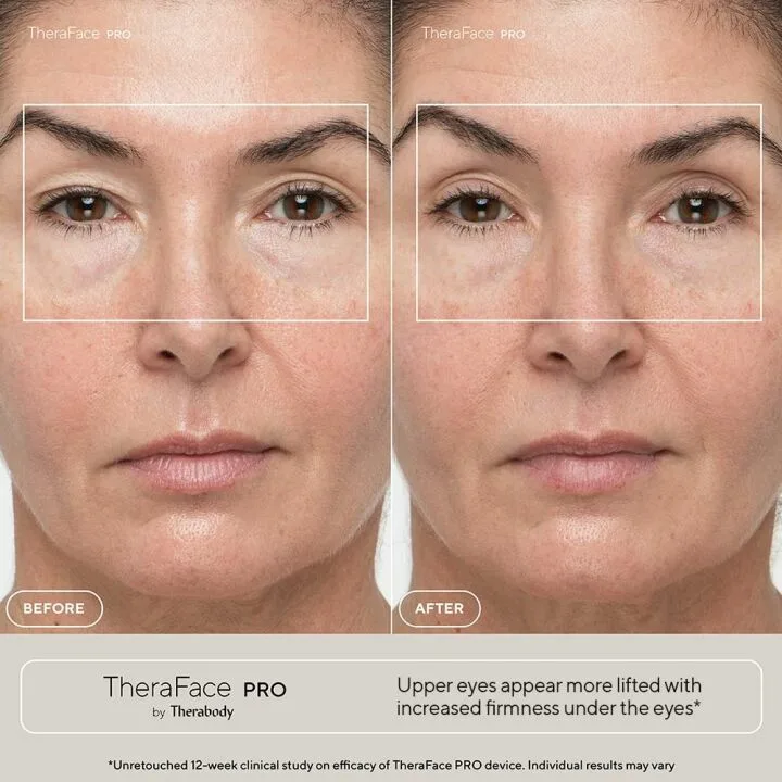 TheraFace PRO Microcurrent Facial Device for Anti-Aging