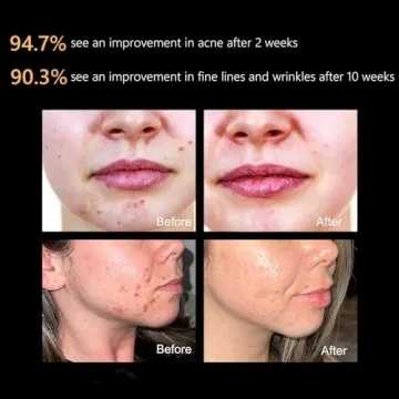 Aphrona LED Facial Skin Care Mask for Glowing Skin