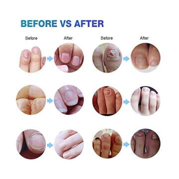 Toenail Fungus Treatment Extra Strength: Nail Fungus Treatment for Toenail - Fungal Nail Repair Pen ...