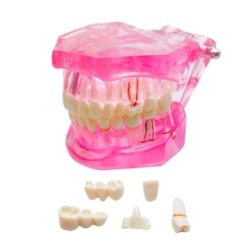 Windplusya Transparent Disease Teeth Model with Dental Implant Bridge, Dental Teach Crown Bridge Rem...