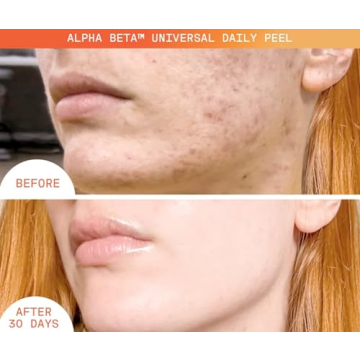 Dr. Dennis Gross Alpha Beta Peel for Youthful Skin
