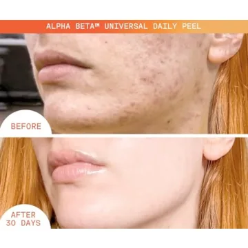 Dr. Dennis Gross Alpha Beta Peel for Youthful Skin