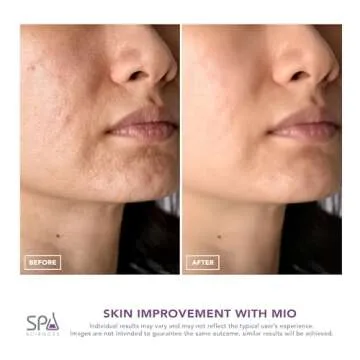 Spa Sciences MIO - Diamond Microdermabrasion for Vital Skin