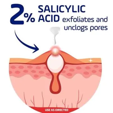 Asepxia Acne Treatment Cream for Face, 2% salicylic acid, Rapid Maximum Strength Acne Treatment, Clears Pimples and Blackheads, Prevents New Acne and Controls Excess Oil, 1 oz