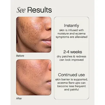 Topicals Like Butter Moisturizer for Eczema Relief and Hydration